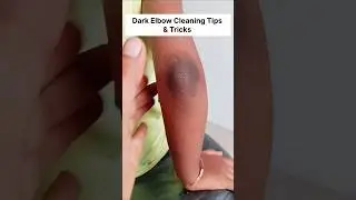 Remove Elbow Darkness In Just 5 Mins | Lighten Dark Elbow, Dark Elbow Cleaning Tips #darkskin #hack