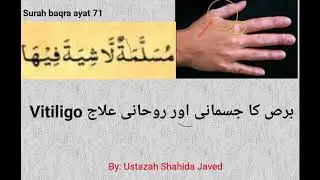 Vitiligo برص کا جسمانی اور روحانی علاج