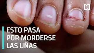 Riesgos por morderse las u&ntilde;as - En Punto