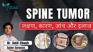 Spine Tumor: लक्षण, कारण, जांच और इलाज | Early Diagnosis Can Save Paralysis | Dr. Amit Chugh | Delhi