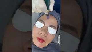 Kỹ thuật phi kim trị th&acirc;m, căng b&oacute;ng da chuẩn Spa