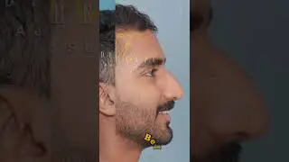 Best Rhinoplasty Result after Hump Reduction - Dr Mathew PC | Nose Surgery in Kerala