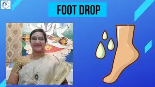 Single Point Acupressure Treatment for Foot Drop (in #kannada)