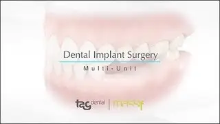 Massif Implant Multi-Unit Surgery