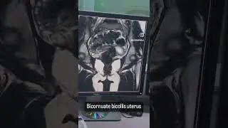 femalepelvis of MRI scan ⚠️