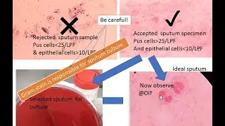 Determination of  the Quality of a Sputum Specimen prior to culturing | Gram stain|  Ideal sputum