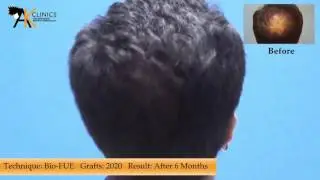 Hair Transplant Before & After result with Bio-FUE, 2020 Graft, India