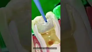 What happens during a root canal treatment? Part 3
