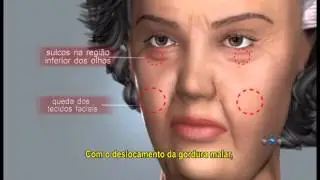 Preenchimentos Facias - &Aacute;cido hialur&ocirc;nico