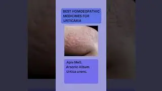 urtica urens homeopathic medicine uses|urticaria treatment|urticaria #medical #homoeopathy#urticaria