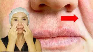 Effective Massage Techniques for the Nasolabial Folds with Instant Lifting Effect