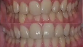 Before & After Braces/time lapse