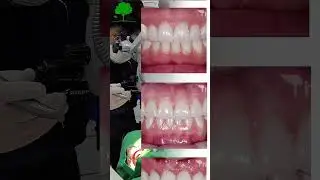 ✨ 1 Day Smile Makeover &ndash; Veneers in South Korea ✨