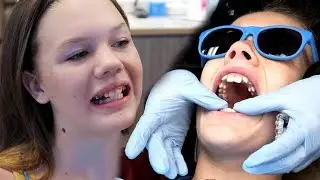 FINALLY! Getting Their Smiles Fixed with Invisalign Aligners | Clintus.tv