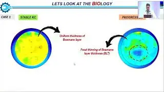 AIOS2025 GP70 T Dr Rohit SHETTY Keratoconus