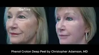 Phenol Croton Deep Peel by Christopher Adamson, MD