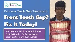 Front Teeth Gap Filling Treatment in Chhatrapati Sambhajinagar | Dr Nawale&rsquo;s DentoCare