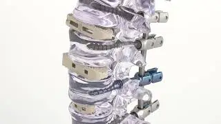 Oblique Lateral Interbody Fusion Cage &mdash; Access Redefined ⚙️🦴