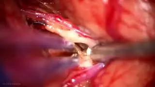 Minipterional Craniotomy and TS-TI Approach for Resection of a Cav Mal in the Limen Insulae
