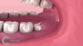 Problem with widsdom teeth