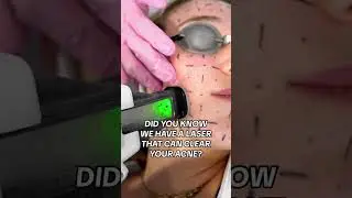 This Laser Clears Acne! #clearskin #acne