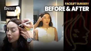 Facelift Surgery Transformations: Before & After | Real Results at Lin Europe Clinic