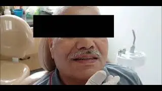 Denture at sj dental care.. for very good dentures call 8095758583