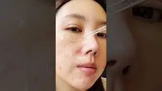 #skin1004  #darkspots  #hyperpigmentaiton  #skincareroutine  #koreanskincare  #centella