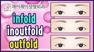 infold & outfold & inoutfold