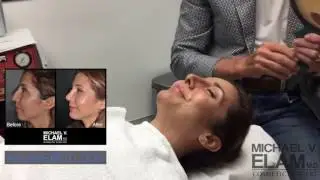 She Waited 20 Years! Rhinoplasty & Chin Implant Reveal with Dr. Elam - #ElamFirstLook