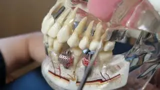 Maxillary Sinus Lift in Implant Dentistry (Intracrestal &/or Lateral)- 101