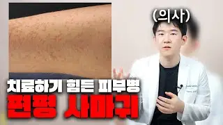 이거 여드름 아닙니다… 편평사마귀입니다