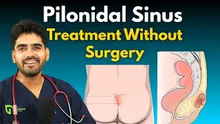 What is Pilonidal Sinus ? Symptoms Causes and Treatment Without Surgery | Doctor Gourav Rathour