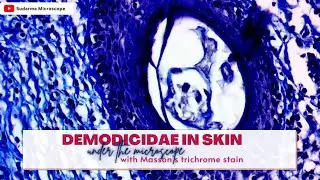 Demodicidae in skin under the microscope with Masson's trichrome stain