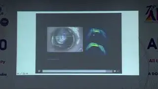 AIOC2020 FP Cornea I Dr PRAFULLA KUMAR MAHARANA Microscope Integrated OCT Guided Stromal Fluid Drain