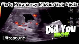 Early Pregnancy Miscarriage - Facts