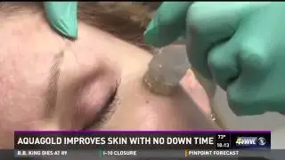 Aquagold treatment New Orleans - Improves skin with no down time