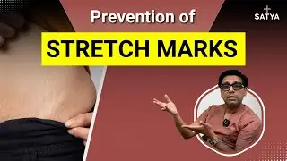 How to Prevent Stretch Marks | Stretch Marks Prevention at Home | Stretch Marks Prevention | Satya