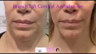 Branch Lift Cervical Ambulatorio (BLCA)