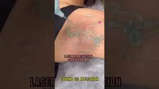 Say Goodbye to waxing/Ingrown Hair/Folliculitis.