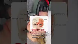 #botoxtraining #botoxbrowlift #botox #botoxday #botoxinjections #botoxinjection #cosmetologytraining