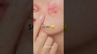 Sensitive skin solution 💬