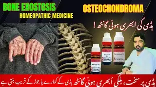 Bone extosis!Osteochondroma Symptoms & Management! Causes Risks & Recovery@homeoTec