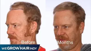 Amazing Hair Transplant after only 5 months - Q95's Gunner