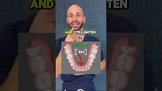 Teeth Crowding in Adults, and How We Fix it With Invisalign.