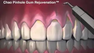 Chao Pinhole Gum Rejuvenation - Chao Pinhole Surgical Technique