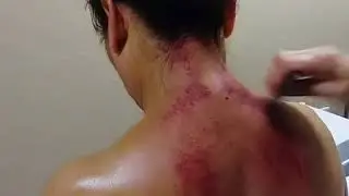 Total Wellness Acupuncture - Gua Sha - Phoenix, AZ