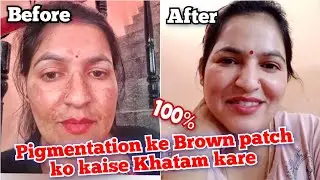 Pigmentation ke Brown Patch ko kaise thik kare | Brown patch Khatam | Cooking with Sultana
