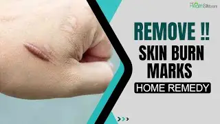 Skin Burn Marks Home Remedies: 5 Hacks To Get Rid Of Burn Marks At Home | Skincare Tips