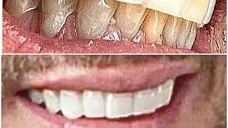  @VeneeraWorld   VENEERA ARE THEY LEGIT?  VENEERA Honest Review  #veneera #veneers  #clipinveneers